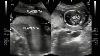 L'échographie Vidéo Affichage Double Placenta Twin Grossesse